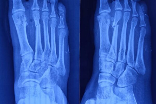 Problems with the Cartiva Implant and representation at KBA
