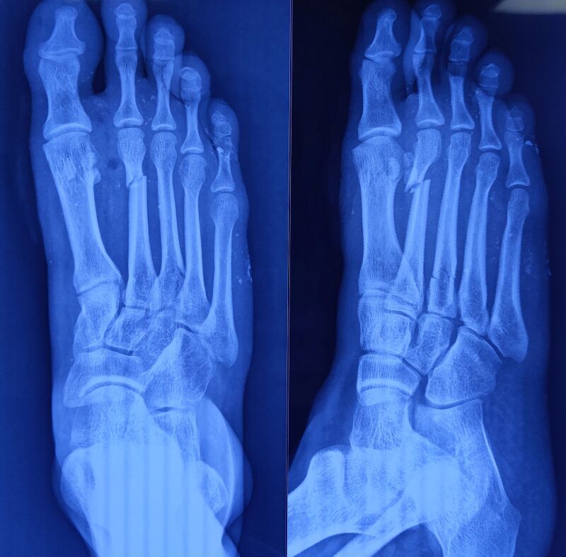 Cartiva Toe Implant Failures